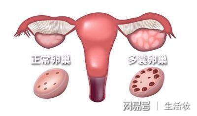 单侧多囊卵巢能怀上孩子吗